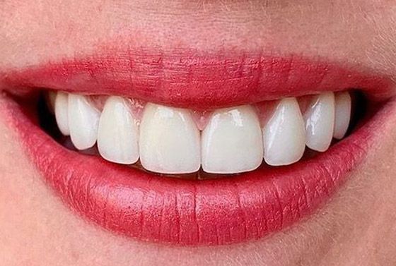 After veneers