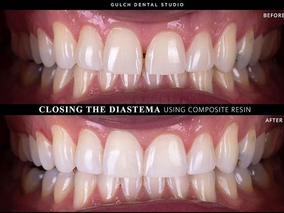 Before and after dental bonding